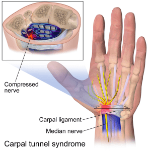 Best mouse outlet for carpal tunnel